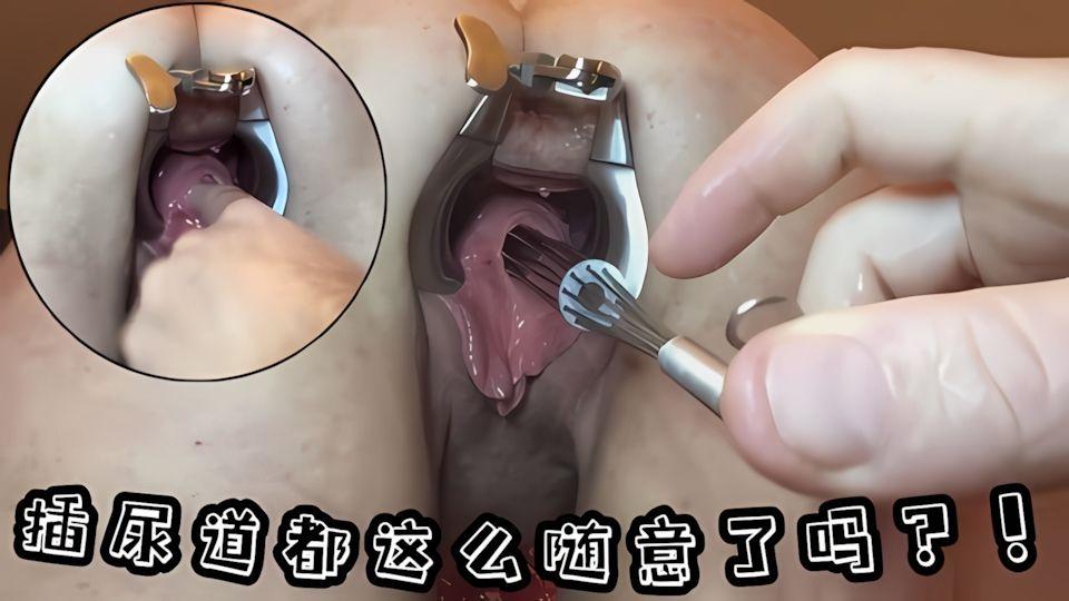插尿道都这么随意了吗