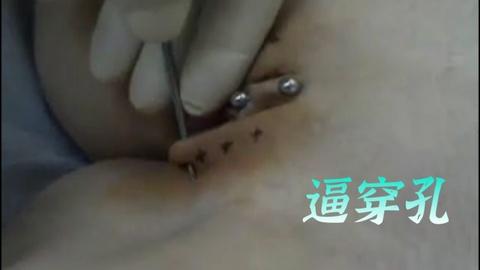 逼穿孔